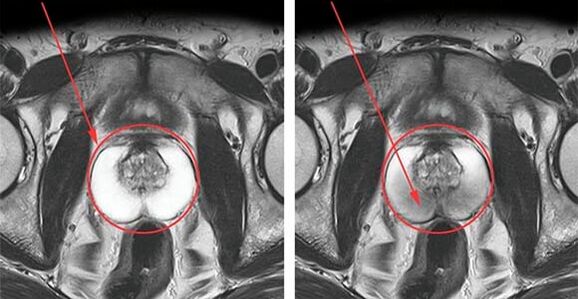 Normal prostate (left) and prostate inflammation with prostatitis (right)